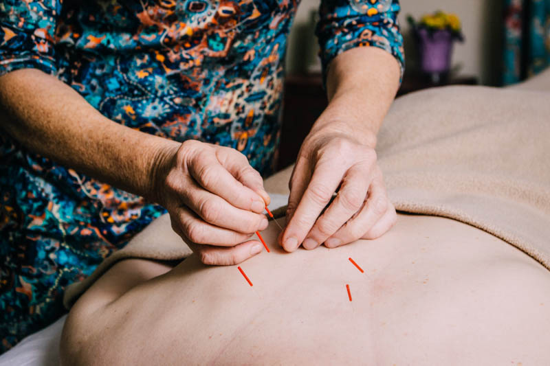 Person with acupuncture needles in back